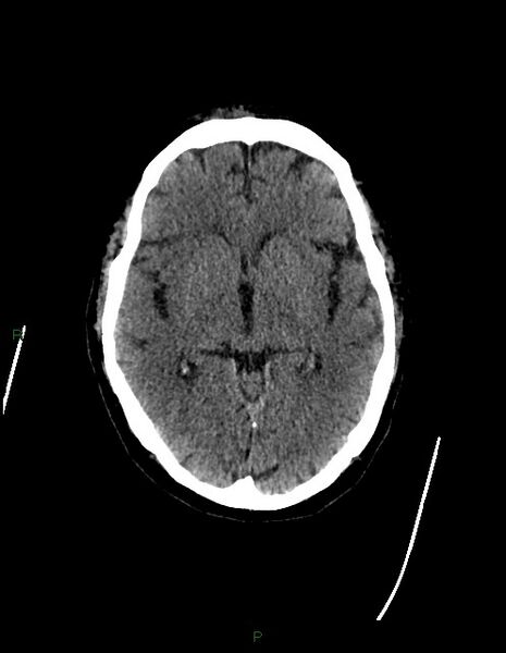 File:Bilateral acute middle cerebral artery territory infarcts (Radiopaedia 77319-89401 Axial non-contrast 40).jpg