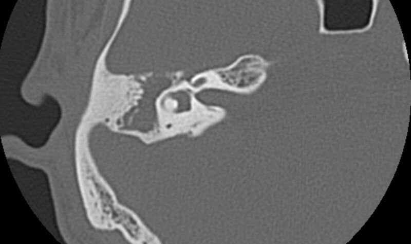 File:Bilateral cholesteatoma (Radiopaedia 54898-61172 Axial bone window 27).jpg
