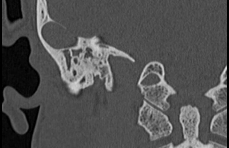 File:Bilateral cholesteatoma (Radiopaedia 54898-61172 Coronal bone window 65).jpg
