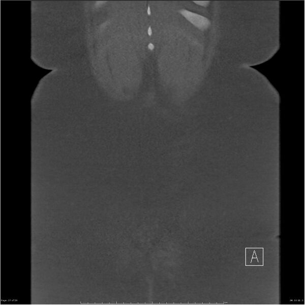 File:Bilateral lumbar ribs (Radiopaedia 25862-26010 Coronal bone window 27).jpg
