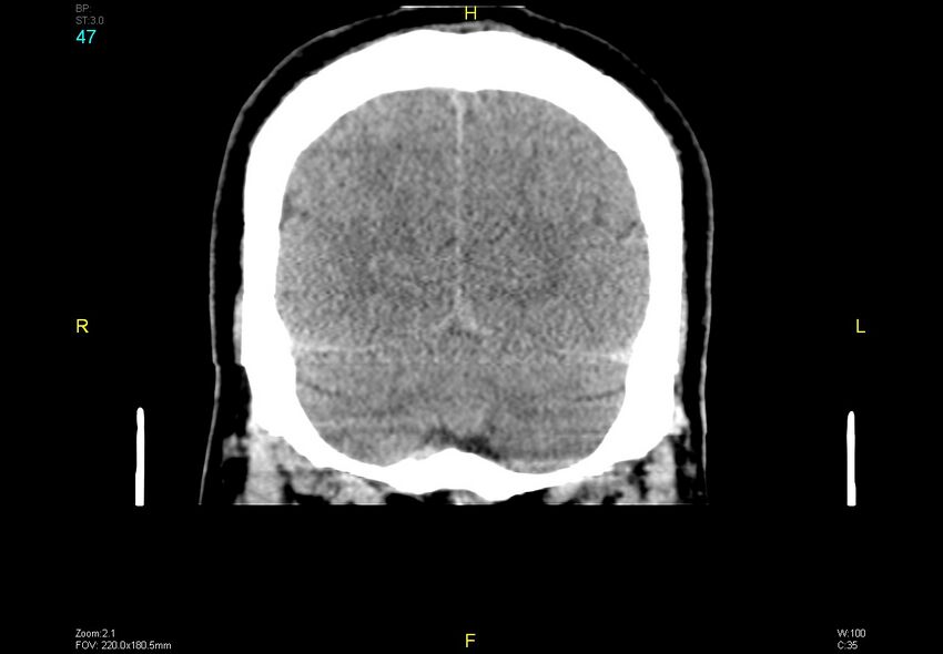 Bilateral medial medullary infarction (Radiopaedia 42220-45295 Coronal non-contrast 47).jpg
