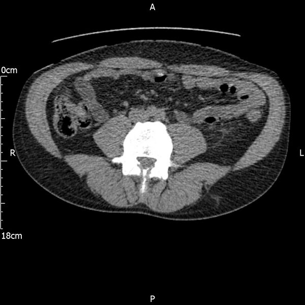 File:Bilateral medullary nephrocalcinosis with ureteric calculi (Radiopaedia 71269-81569 Axial non-contrast 73).jpg