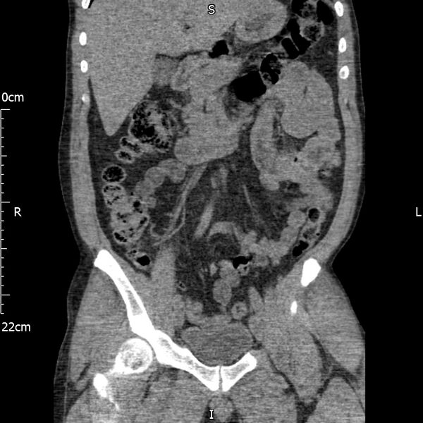 File:Bilateral medullary nephrocalcinosis with ureteric calculi (Radiopaedia 71269-81569 Coronal non-contrast 27).jpg