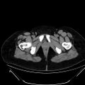 Bilateral ovarian mature cystic teratomas (Radiopaedia 79373-92457 Axial non-contrast 95).jpg