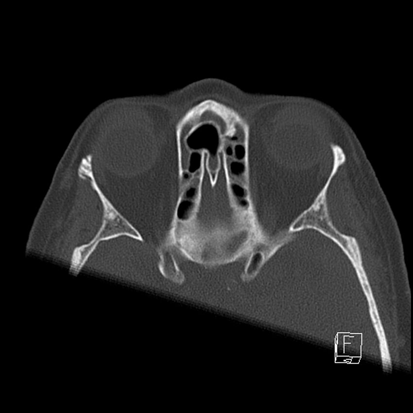 Bilateral palatine tonsilloliths on OPG and CT (Radiopaedia 75167-86247 Axial bone window 4).jpg