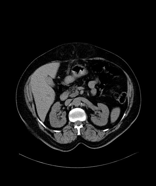 File:Bilateral sporadic synchronous clear cell renal cell carcinoma (Radiopaedia 85035-100572 Axial non-contrast 25).jpg