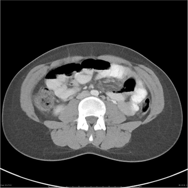 File:Bilateral ureteritis and cystitis (Radiopaedia 25340-25594 A 40).jpg