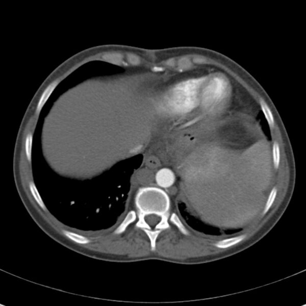 File:Biliary necrosis - liver transplant (Radiopaedia 21876-21846 A 8).jpg