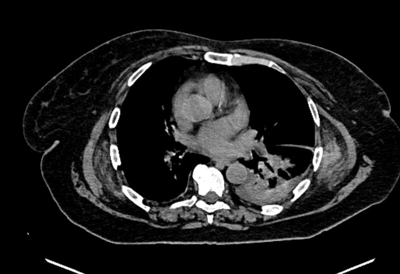 File:Biliary pancreatitis (Radiopaedia 72289-82823 Axial non-contrast 2).jpg