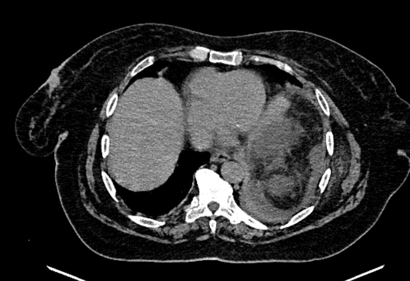 File:Biliary pancreatitis (Radiopaedia 72289-82823 Axial non-contrast 26).jpg