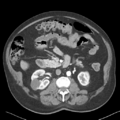 Bladder papillary urothelial carcinoma (Radiopaedia 48119-52951 A 21).png