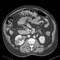 Bladder papillary urothelial carcinoma (Radiopaedia 48119-52951 Axial 21).png