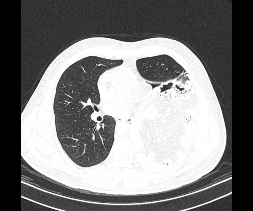 Bochdalek hernia - adult presentation (Radiopaedia 74897-85925 Axial lung window 24).jpg