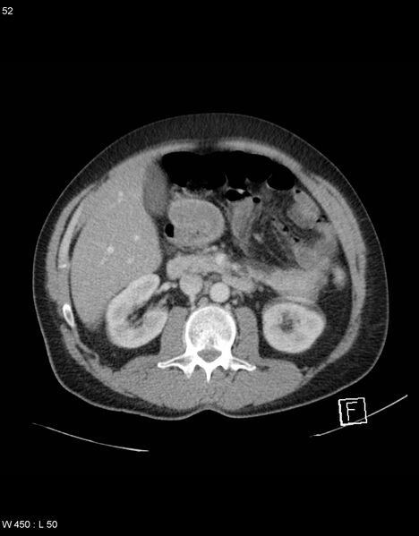File:Boerhaave syndrome with tension pneumothorax (Radiopaedia 56794-63603 A 26).jpg