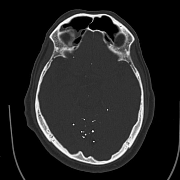 File:Brain Pantopaque remnants (Radiopaedia 78403-91048 Axial bone window 31).jpg