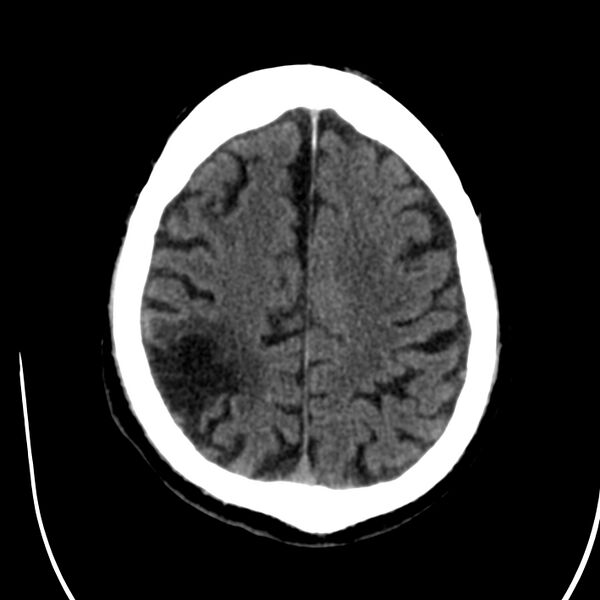 File:Brain Pantopaque remnants (Radiopaedia 78403-91048 Axial non-contrast 68).jpg
