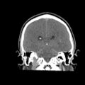 Brain death (Radiopaedia 78597-91360 Coronal non-contrast 48).jpg