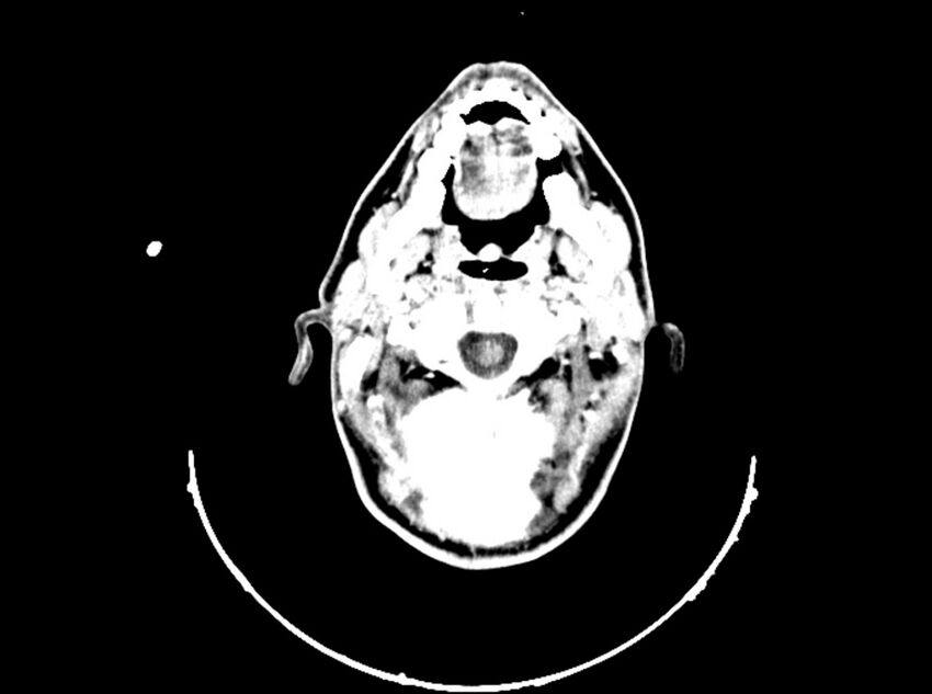 Brain injury by firearm projectile (Radiopaedia 82068-96088 B 54).jpg