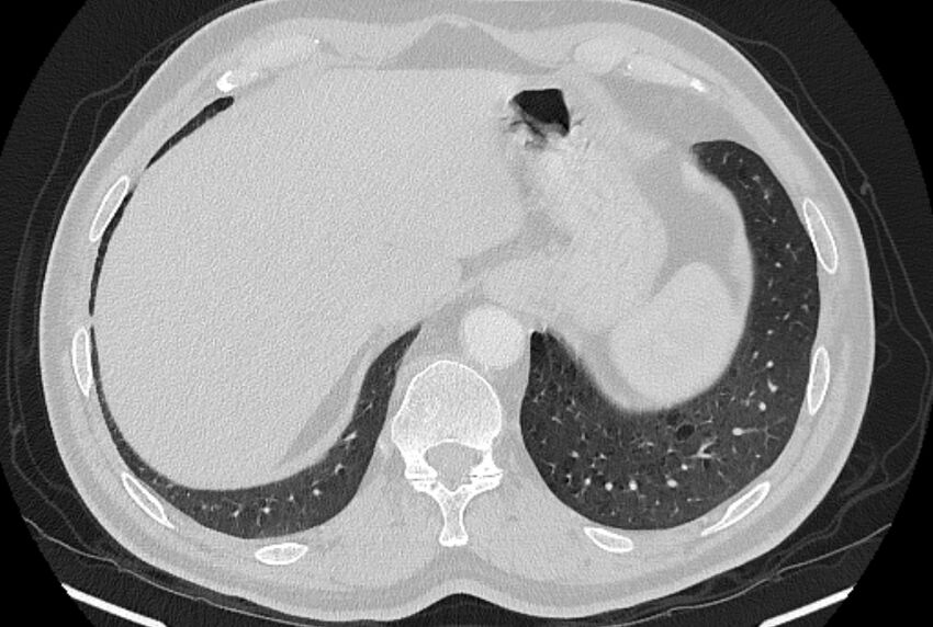 Brain metastases - lung cancer primary (Radiopaedia 75060-86116 Axial lung window 53).jpg