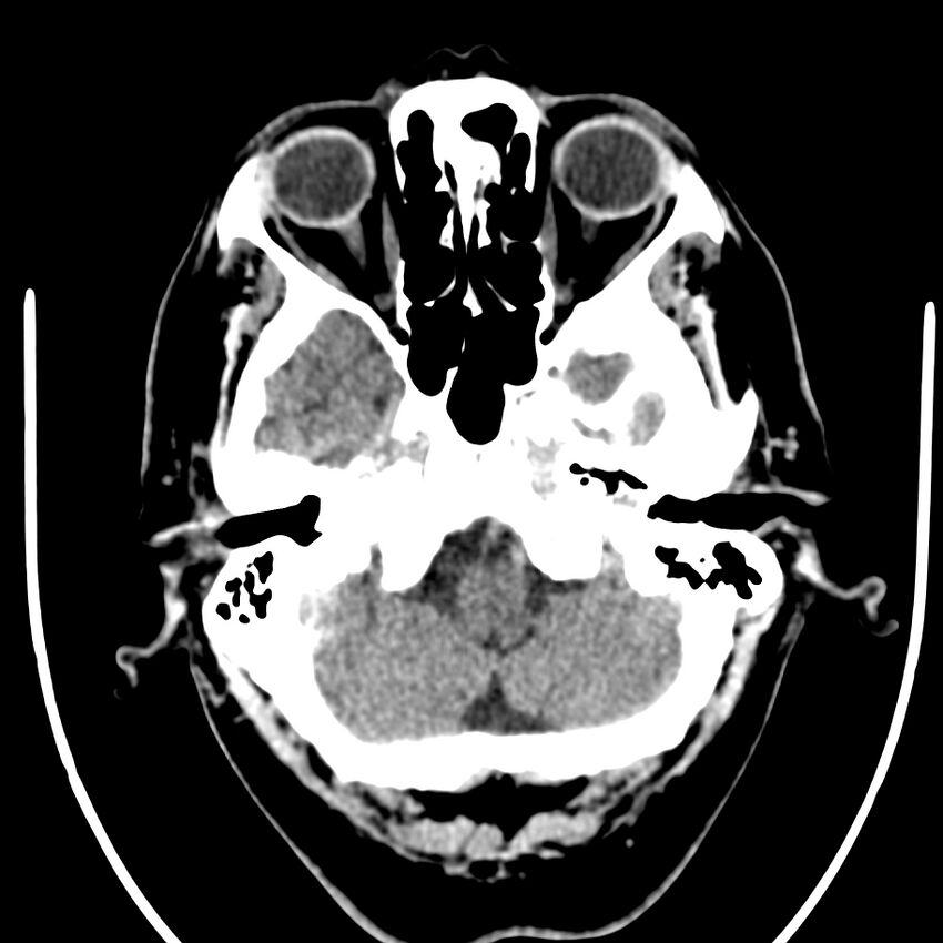 Brain metastasis (Radiopaedia 42617-45760 Axial non-contrast 5).jpg