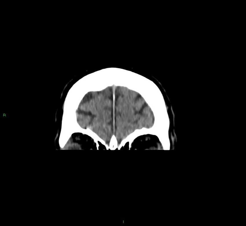 Brainstem hemorrhage (Radiopaedia 58794-66028 Coronal non-contrast 57).jpg