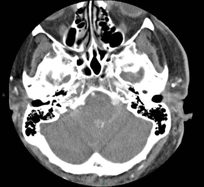 File:Brainstem hemorrhage (Radiopaedia 58794-66028 D 40).jpg