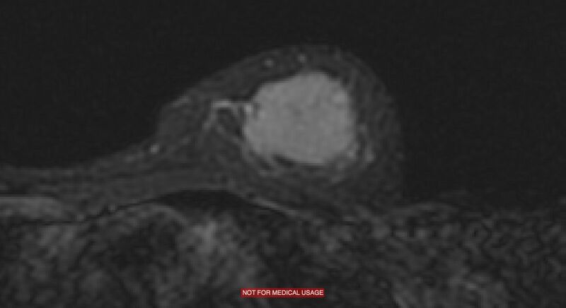 File:Breast lymphoma (MRI) (Radiopaedia 34999-36498 Axial STIR 9).jpg