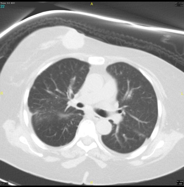 File:Breast primary with lung and bone metastases (Radiopaedia 40620-43228 Axial lung window 22).jpg