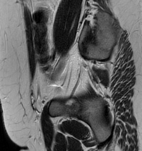 File:Broad ligament leiomyoma (Radiopaedia 81634-95516 Sagittal T2 25).jpg