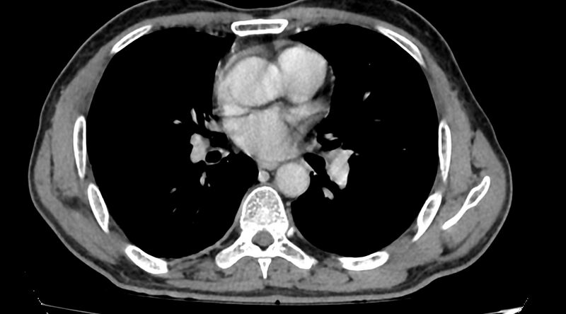 File:Bronchogenic carcinoma with superior vena cava syndrome (Radiopaedia 36497-38054 Axial C+ delayed 54).jpg