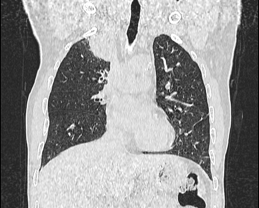 Bronchogenic carcinoma with superior vena cava syndrome (Radiopaedia 36497-38054 Coronal lung window 23).jpg