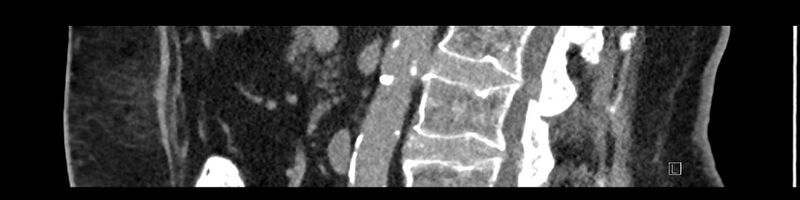 File:Buried bumper syndrome - gastrostomy tube (Radiopaedia 63843-72575 Sagittal Inject 62).jpg