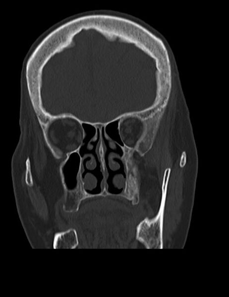 File:Burnt-out meningioma (Radiopaedia 51557-57337 Coronal bone window 13).jpg