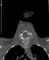 Butterfly vertebra (Radiopaedia 77903-90209 Coronal bone window 40).jpg