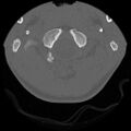 C5 facet fracture (Radiopaedia 58374-65499 Axial bone window 9).jpg