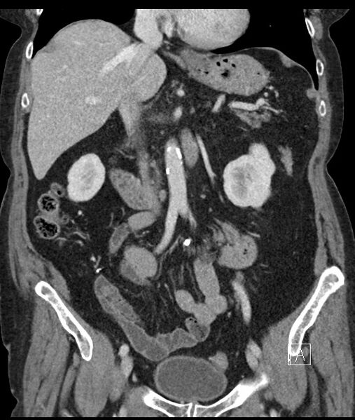File:Calcified adrenal glands and Spigelian hernia (Radiopaedia 49741-54988 B 52).jpg