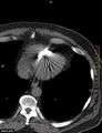 Calcified cardiac fibroma (Radiopaedia 39267-41519 Axial non-contrast 11).jpg