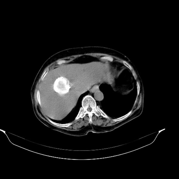 File:Calcified hydatid cyst (Radiopaedia 62000-70085 Axial non-contrast 24).jpg