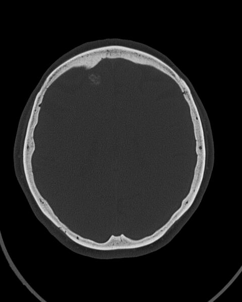 File:Calcified meningioma (Radiopaedia 74361-85243 Axial bone window 18).jpg
