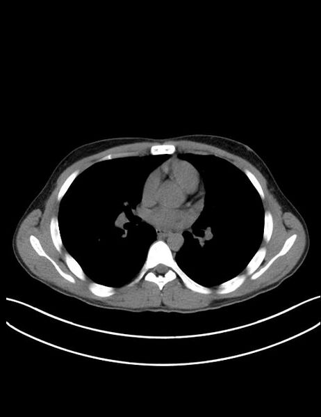 File:Calcifying pulmonary metastases (Radiopaedia 33359-34396 Axial non-contrast 16).jpg