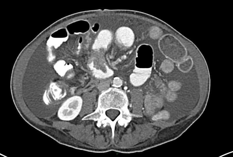 File:Carcinoid mesenteric tumor complicated by chylous ascites (Radiopaedia 76312-87953 A 42).jpg