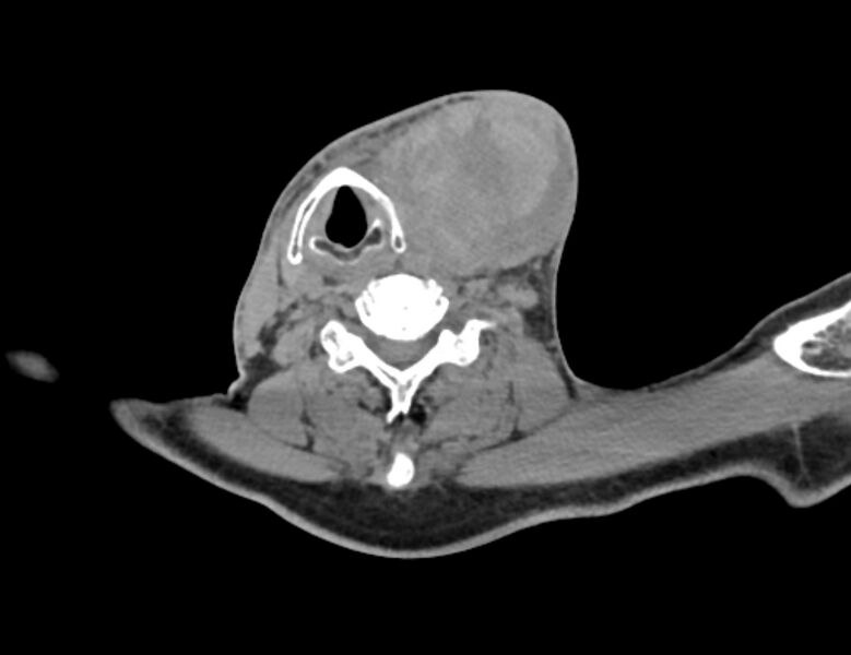 File:Carotid artery pseudoaneurysm (Radiopaedia 84030-99259 Axial non-contrast 35).jpg