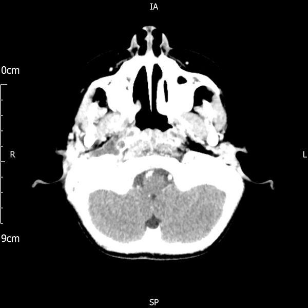 File:Cavernous sinus thrombosis (Radiopaedia 79414-92510 Axial Brain 52).jpg