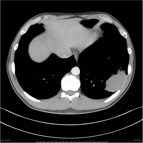 File:Cavitating lung cancer (Radiopaedia 25796-25945 C+ arterial phase 49).jpg