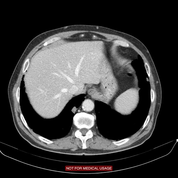 File:Cavitating pulmonary metastases (Radiopaedia 24920-25184 B 25).jpg
