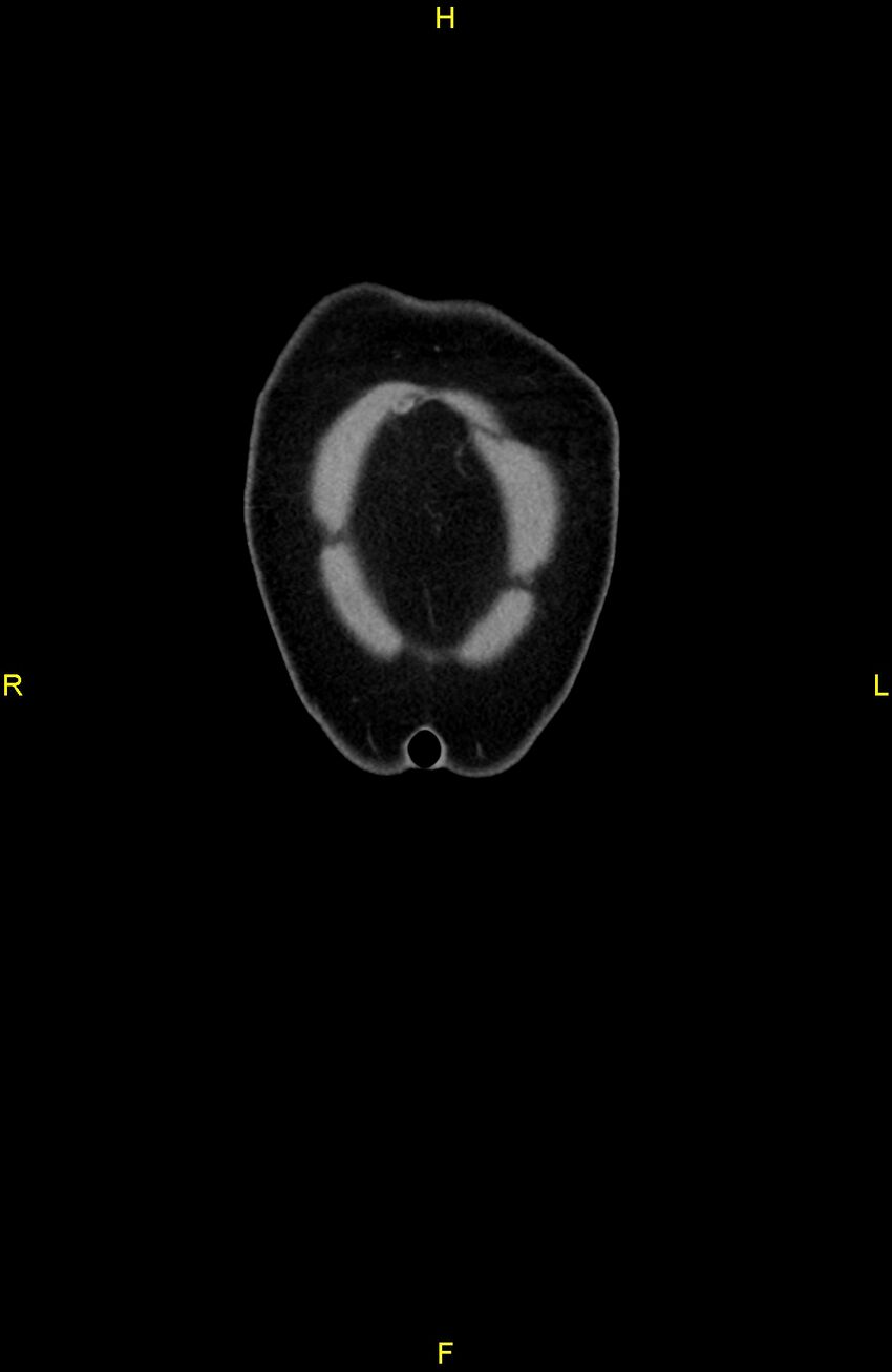 Cecal epiploic appendagitis (Radiopaedia 86047-102164 B 3).jpg