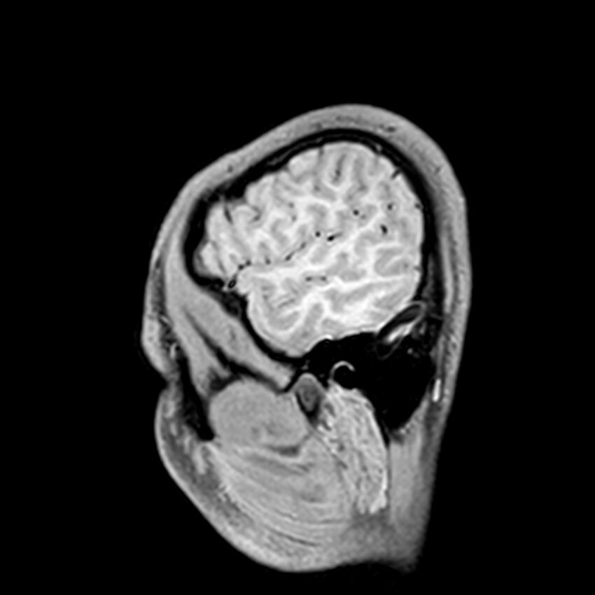 Central neurocytoma (Radiopaedia 79320-92380 Sagittal T1 40).jpg