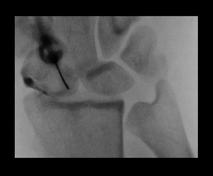 File:Central triangular fibrocartilage perforation (Radiopaedia 73346-84096 Dorsoventral 8).jpg