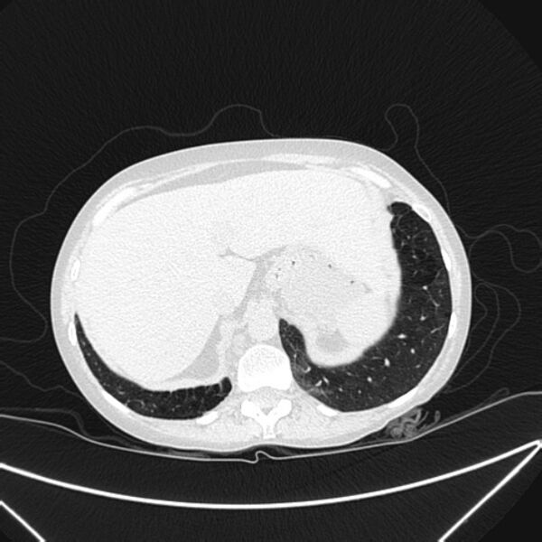 File:Centrilobular pulmonary emphysema (Radiopaedia 24495-24789 Axial lung window 84).jpg