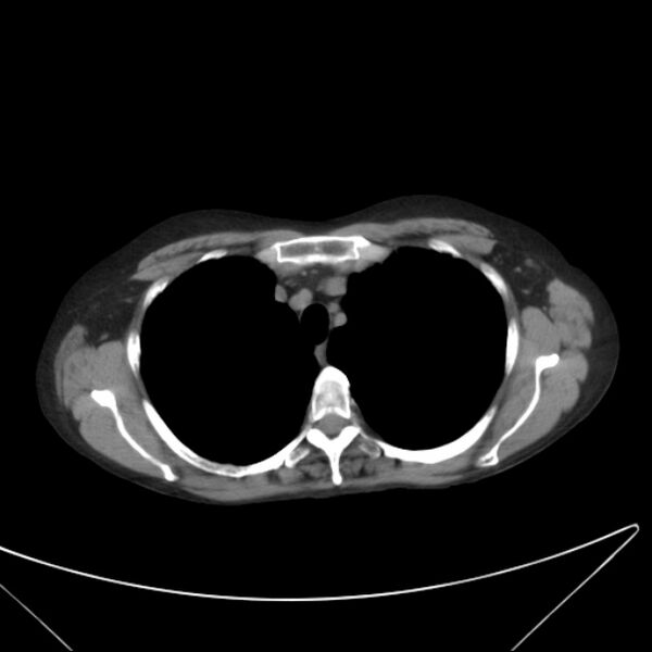 File:Centrilobular pulmonary emphysema (Radiopaedia 24495-24789 Axial non-contrast 10).jpg